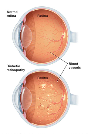 Retinal Care Photo
